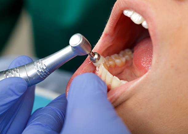 Best Dental Fillings (Composite and Amalgam)  in Westfield, IN